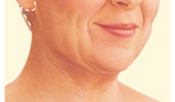 Yüz Germe Ameliyatları