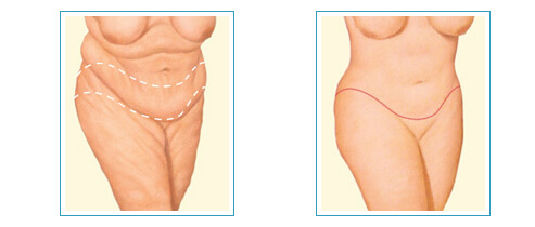 Body-Contouring (Vücut Hatlarının Estetik Ameliyat İle Düzeltilmesi)