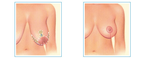 Göğüs dikleştirme