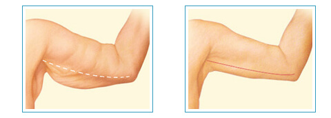 Kol sarkıklığı tedavisi