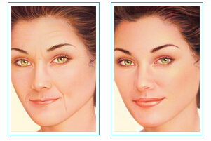 Yüz Dolgu Uygulaması