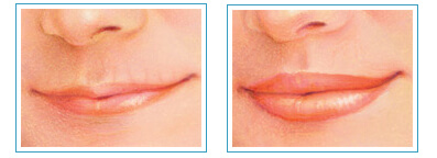 Dudak Dolgu Uygulaması