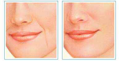 Dudak Dolgu Uygulaması