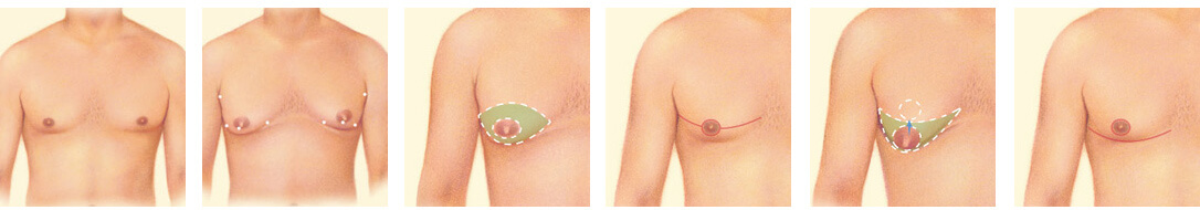 Erkeklerde Göğüs Küçültme