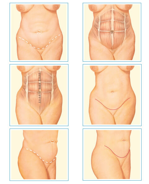 Ameliyat Bölgesinde Kesi Açma