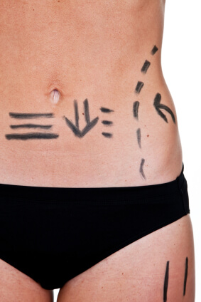 Liposuction (Yağ Aldırma)