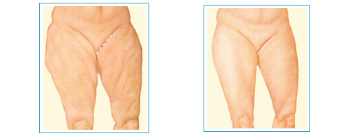 İç (Mediyal) Uyluk Germe