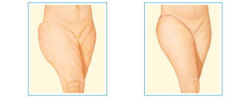 Dış (Lateral) Uyluk Germe